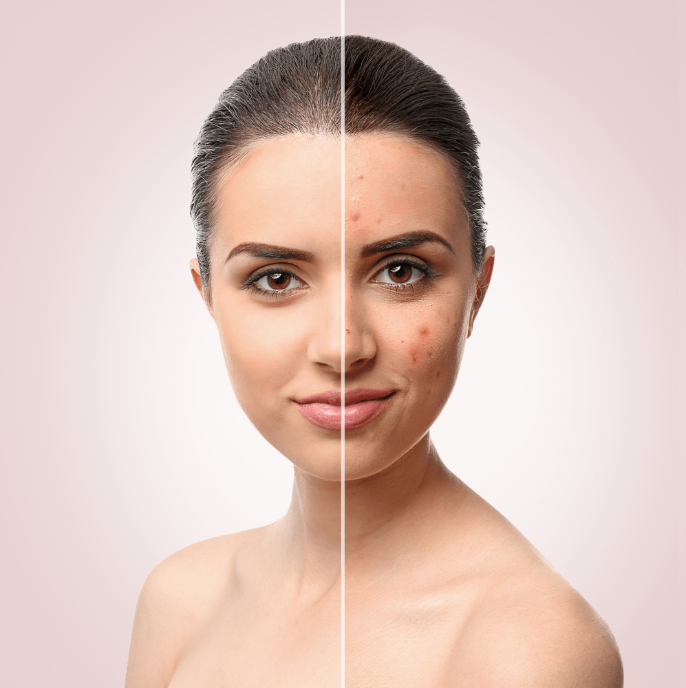 Dealing With Acne And Skin Blemishes  Ebook  Complexion By Design